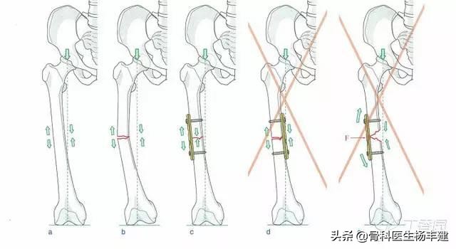 股骨骨折钢板断裂原因分析,骨折钢板在什么情况下容易断裂