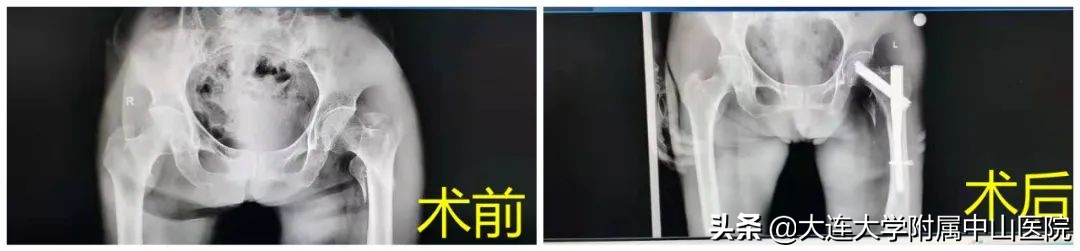 胫腓骨粉碎性骨折自愈动画演示,骨折恢复成功案例