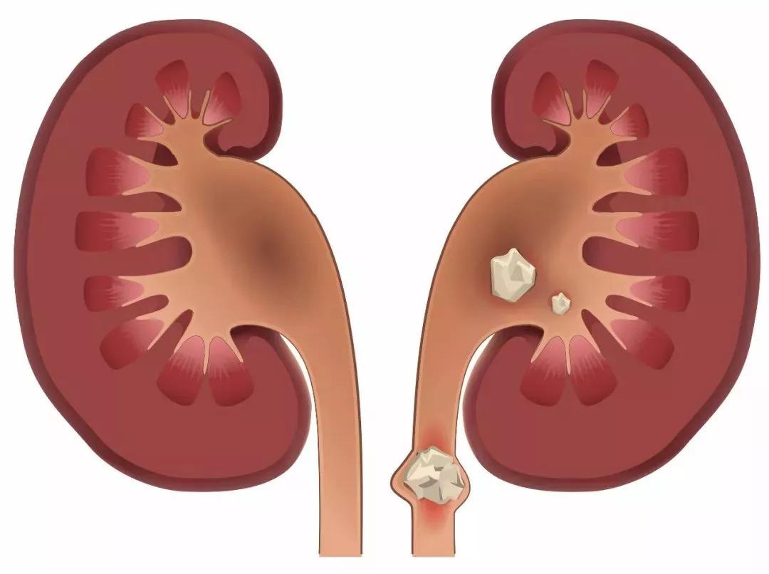 罕见肾部疾病，多发性肾囊肿，了解患病的多种原因，做到积极预防