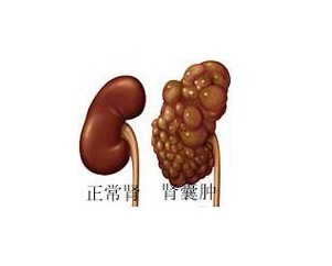 囊肿息肉结节体质如何中医调理,囊肿增生息肉