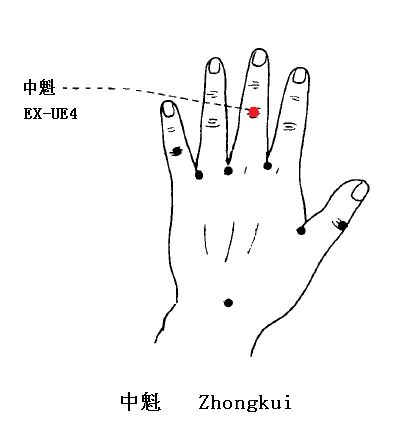 顽固性打嗝针灸扎什么地方,董氏奇穴治疗打嗝的针灸视频