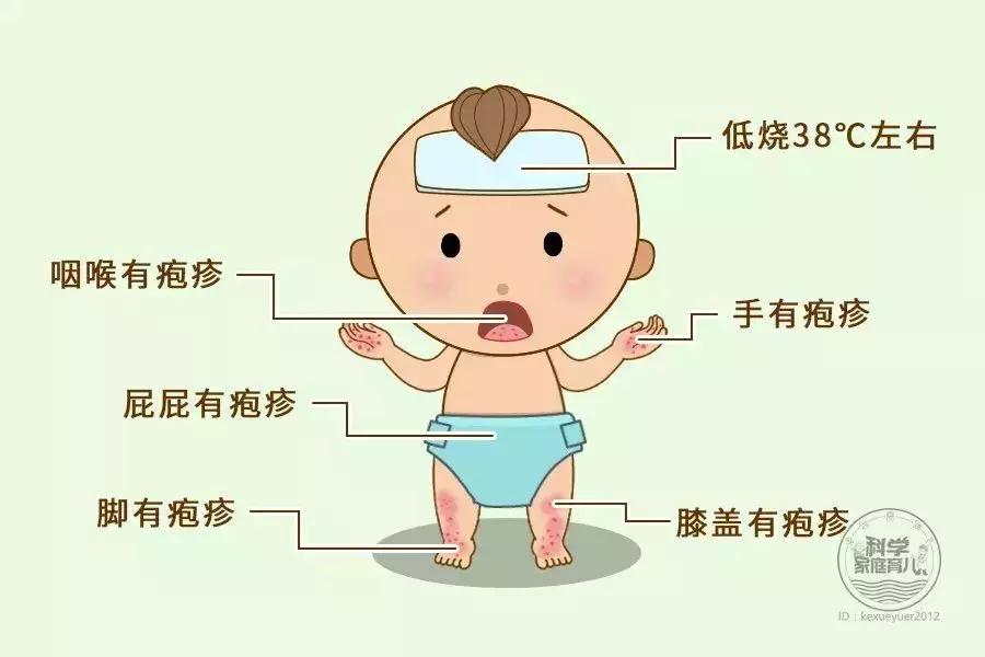 这一步才是治疗疱疹性咽峡炎的关键！做好预防和护理注意3件事