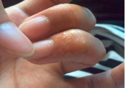 春天来了脚丫奇痒无比怎么办,手脚奇痒无比怎么缓解