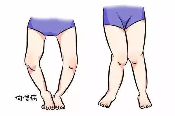 宝宝小腿弯曲需要捆腿吗？儿科医生告诉你如何预防宝宝罗圈腿