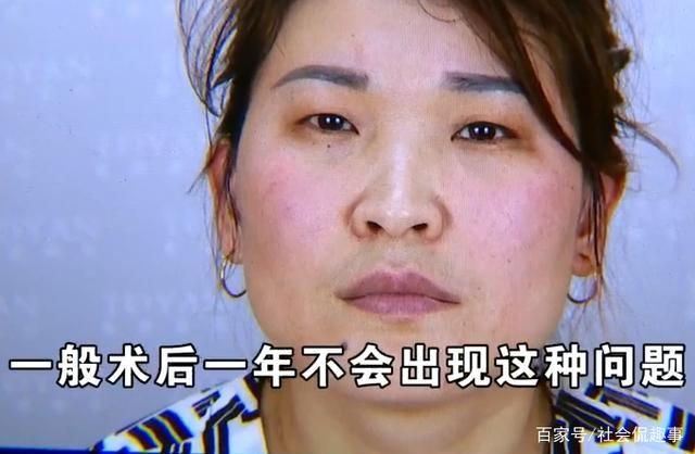 整容鼻子眼睛肿了怎么办,整容眼睛肿