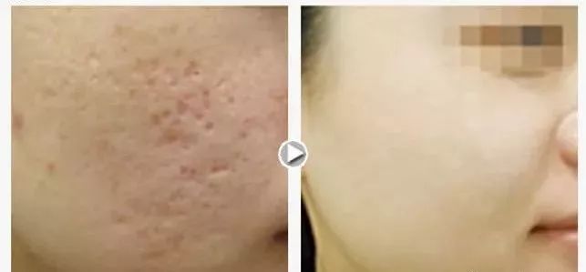 月球表面的痘坑能去掉吗,像毛孔一样的痘坑怎么修复