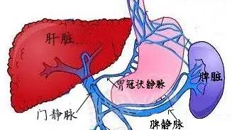 肝硬化引起门脉高压消化道出血,肝硬化消化道大出血怎么治疗