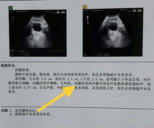 前列腺钙化灶可以用冲击波治疗吗,治疗前列腺钙化灶的药物有哪些