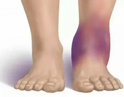 手外伤止血健康宣教,抗凝剂皮下出血原因和临床表现