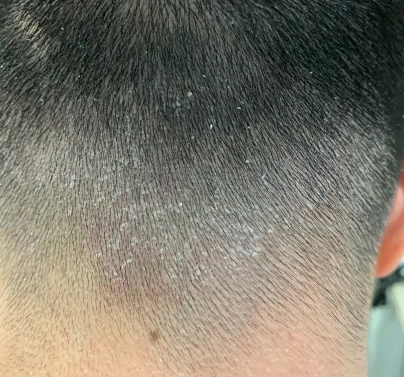 哺乳期头上痒有头皮屑起疙瘩,头上有大块的头皮屑胸下面有疙瘩