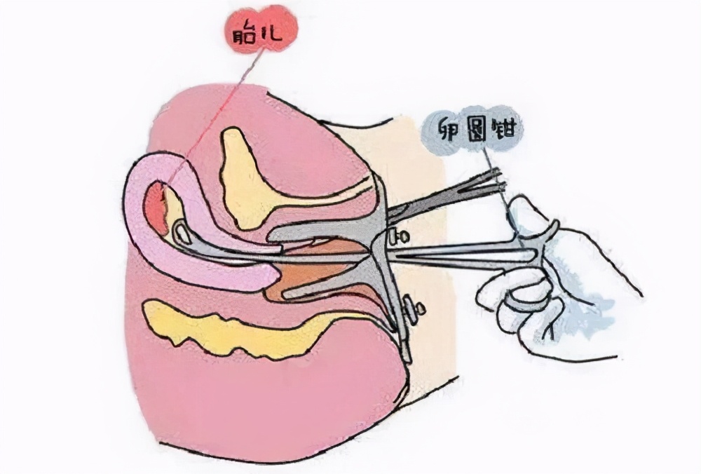 子宫后位怀孕要注意什么问题,子宫后位怀孕有影响吗