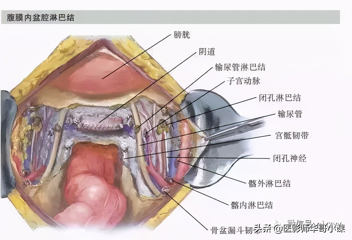盆腔动脉血管解剖图谱,盆腔解剖图谱手绘
