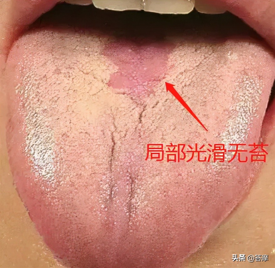 舌象脏腑图,体内有湿寒的舌象