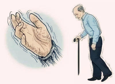 帕金森病患者的家庭护理,帕金森患者的照护流程