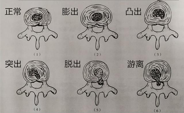 目前最好治疗腰椎间盘突出的方法,腰椎间盘突出治疗最好方法的讲解