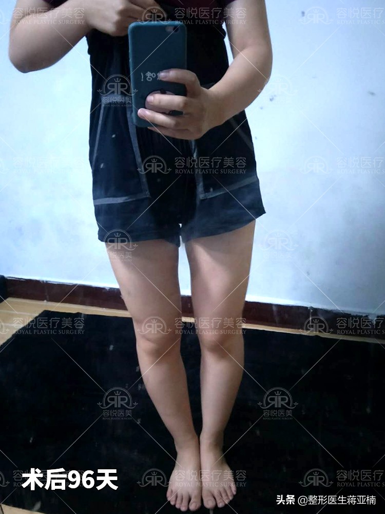 腿细腿部吸脂,大腿吸脂立马变细吗