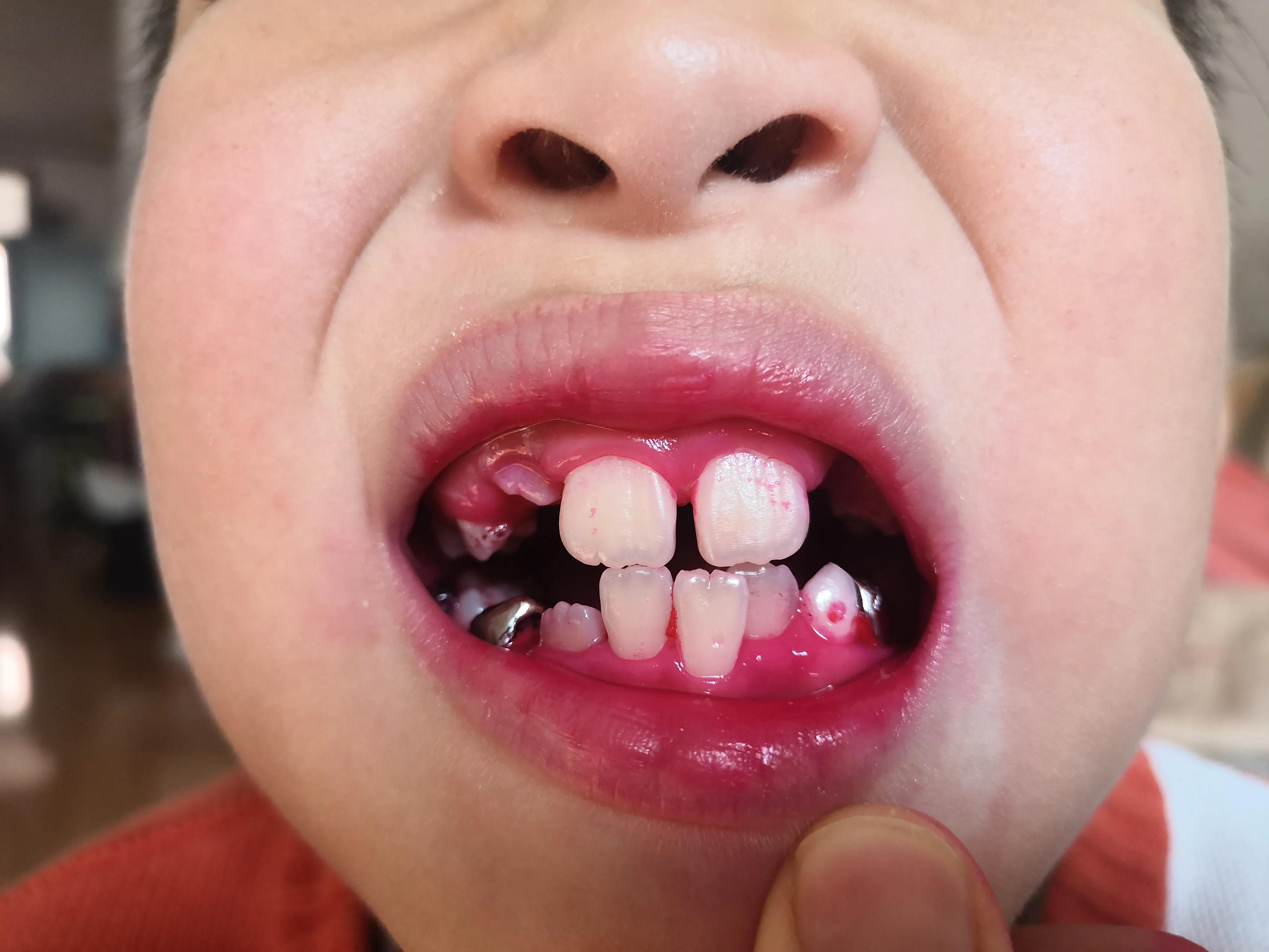 口腔卫生保健讲座第三讲牙菌斑及牙结石