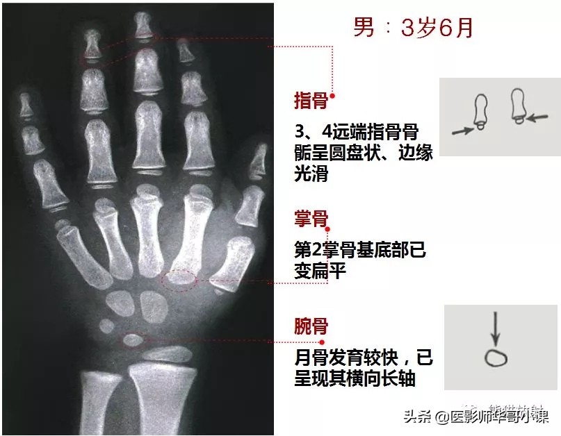 骨龄片对照图谱测骨龄准不,骨龄14岁男孩骨龄图谱