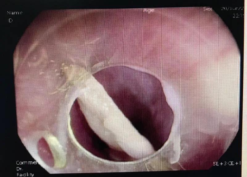 吃鸭脖被骨头卡住了怎么办,鸭头骨头卡食管