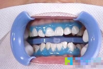 冷光牙齿美白的方法有哪些,viva冷光和皓齿冷光美白的区别