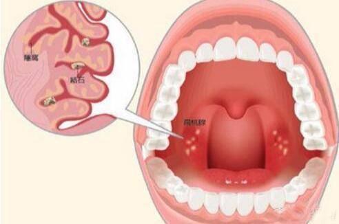 入秋后嗓子疼怎么回事,嗓子干疼伴有咳嗽怎么回事呢