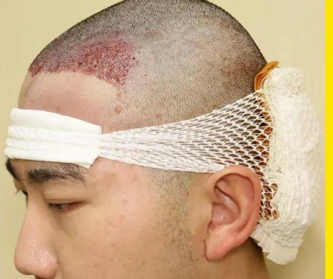 艾滋病患者皮肤会出现什么症状,皮肤瘙痒变硬脱皮是艾滋病症状