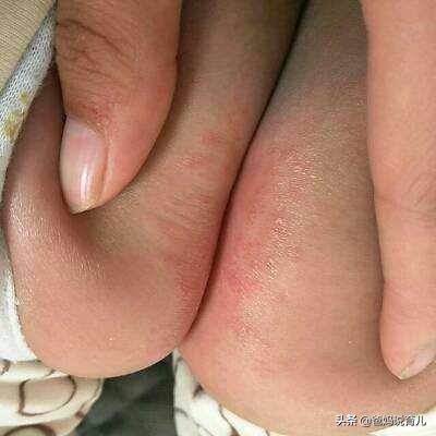 宝宝红屁股反复抹什么药,宝宝红屁股反反复复该怎么办