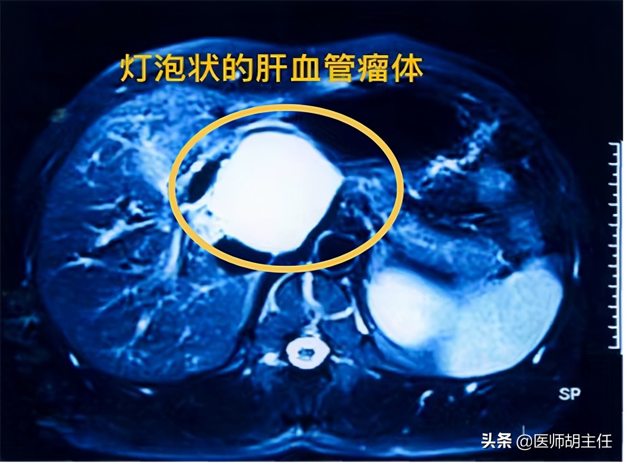 为什么外国人肝血管瘤不用治疗,发现脑血管瘤需要做手术吗
