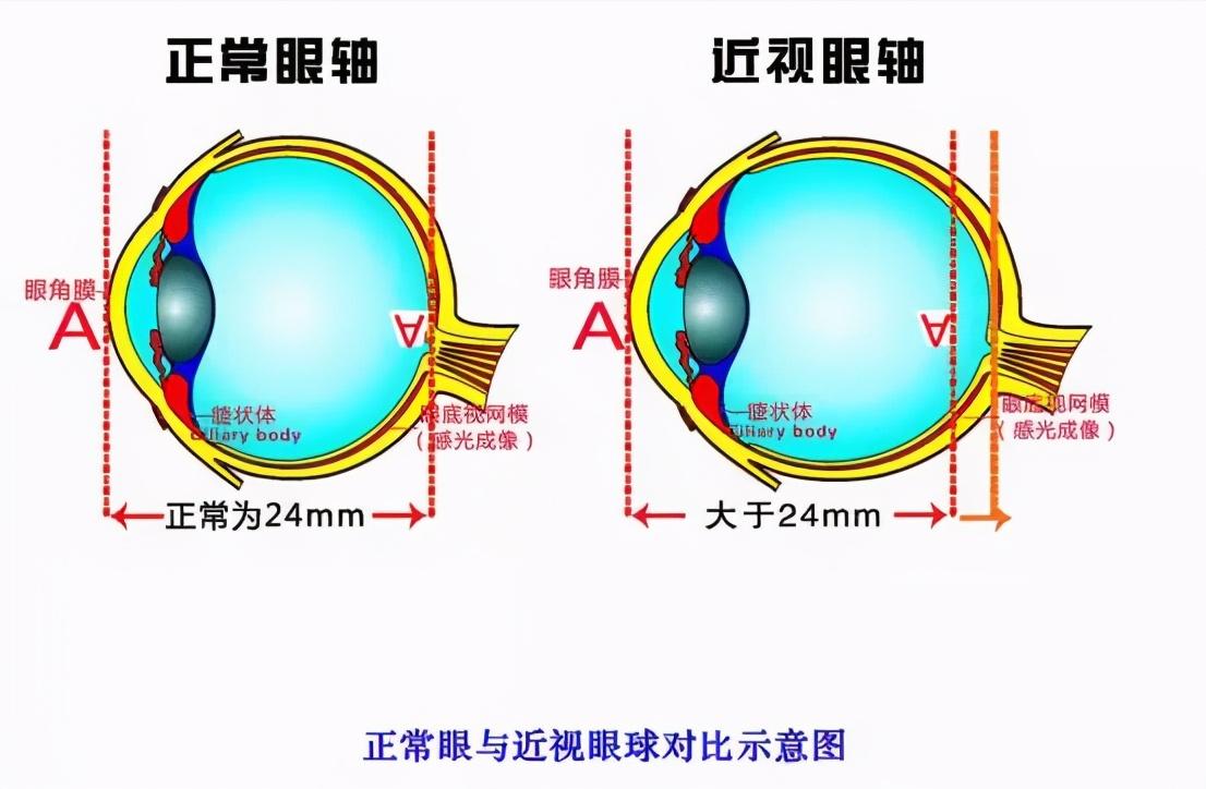 高度近视还有必要护眼吗,中国近视600度以上的人多吗