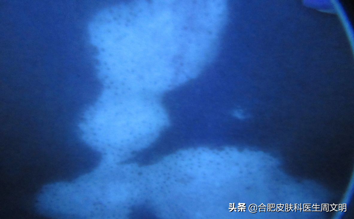 白癜风是皮肤病难治的第几种,鼻子下方嘴巴上的白癜风难治吗