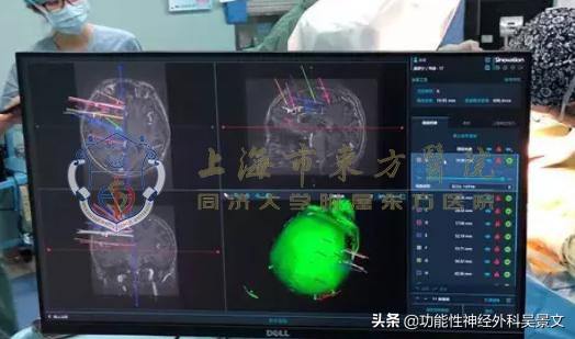 seeg微创手术技术,seeg微创怎么治疗癫痫