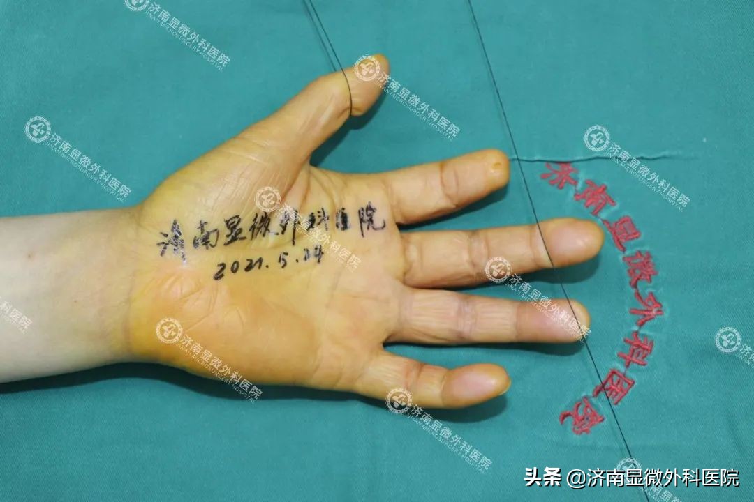 日本手指缺失修复,多年前断手指修复