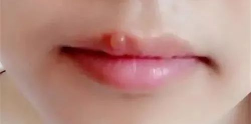 孕早期嘴角起小水泡最快消除方法,孕妈妈嘴角长泡怎么处理