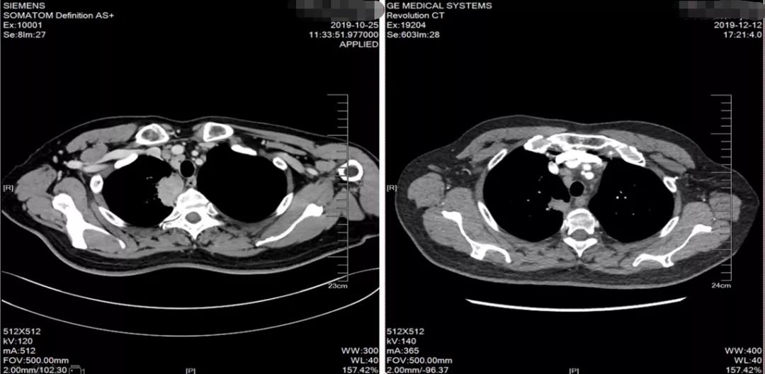 肺癌晚期可以靶向加免疫治疗吗,肺癌晚期化疗加免疫治疗有效吗