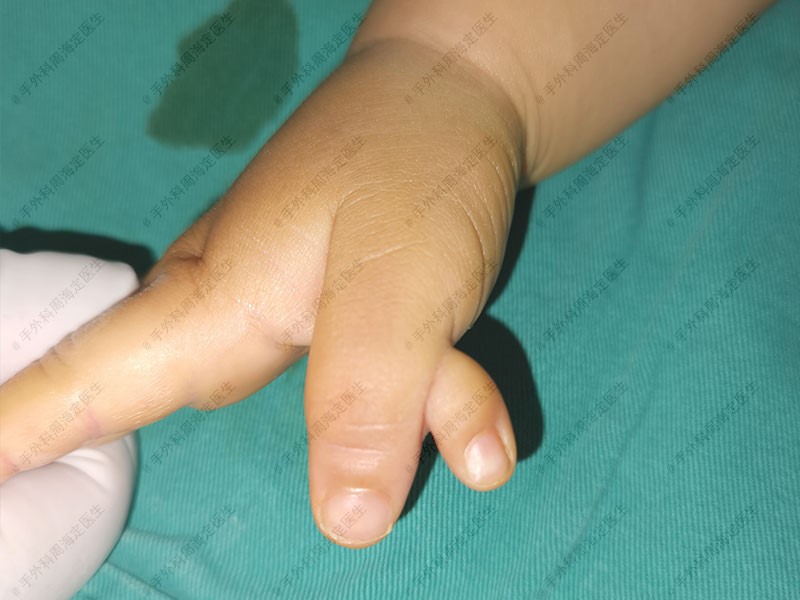 先天性斜指畸形手术修正,复指斜指畸形矫正