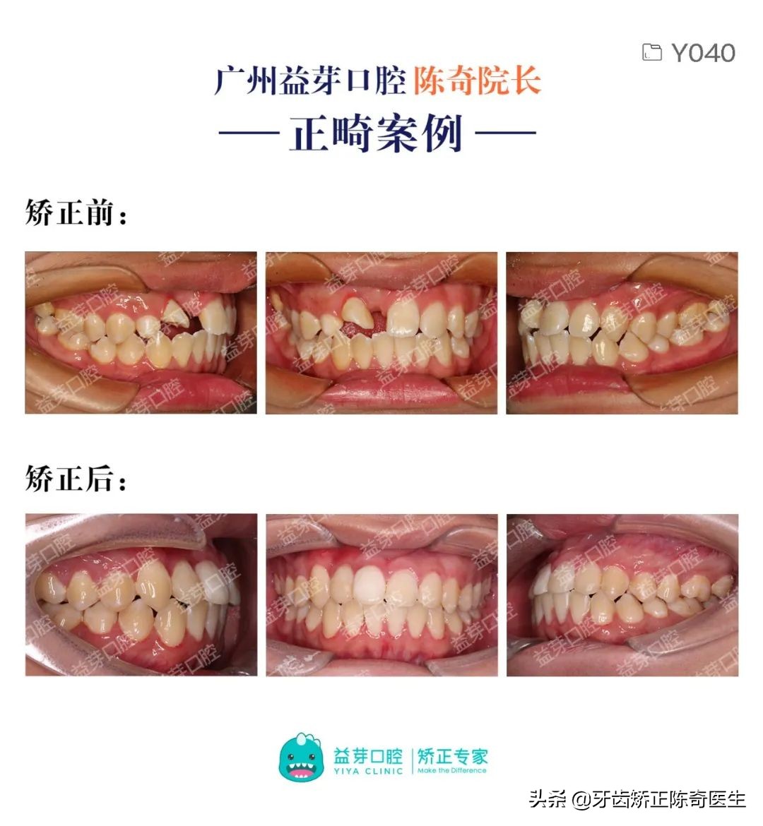埋伏牙用隐形牙套怎么牵引,龅牙隐形牙套矫正全过程