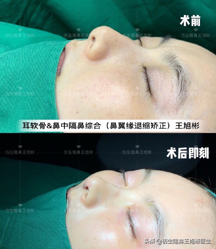 王旭彬：朝天鼻、露鼻孔，模特菲菲短鼻矫正手术后1.5个月