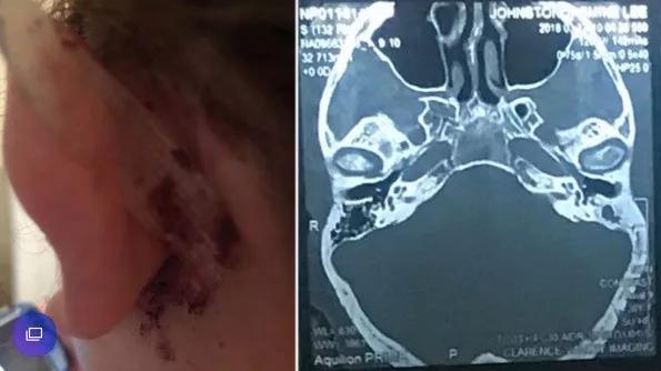 用棉签掏耳朵的危害动画,用棉签掏耳朵对身体有害吗
