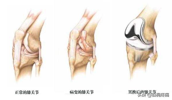 老年人膝盖变形疼痛怎么办,老年人膝关节痛严重变形怎么治疗