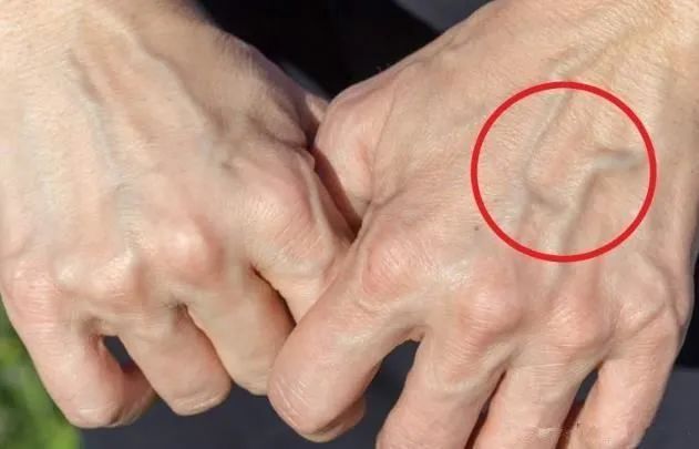 皮肤上的青筋,最近血管青筋比较明显