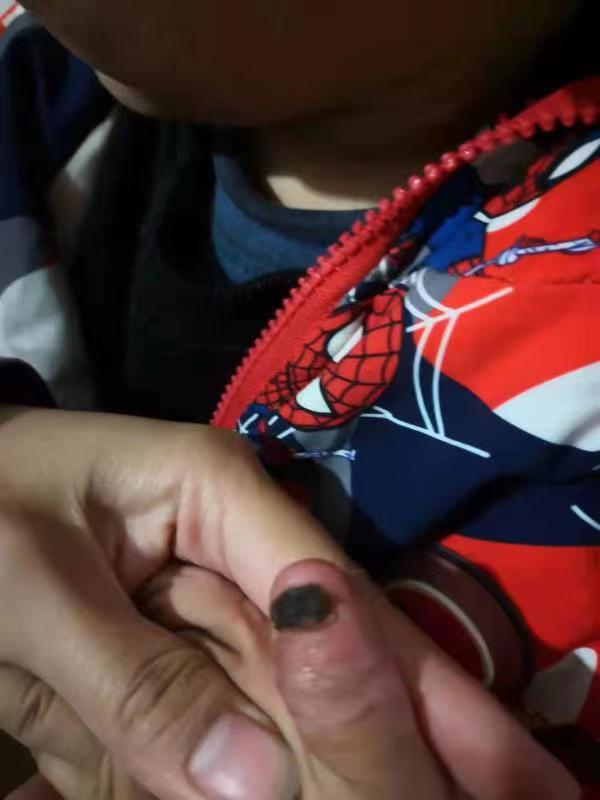 橡皮筋缠绕3天，2岁男童手指紫黑险些截肢！医生提醒：生活中孩子的异常表现需被重视