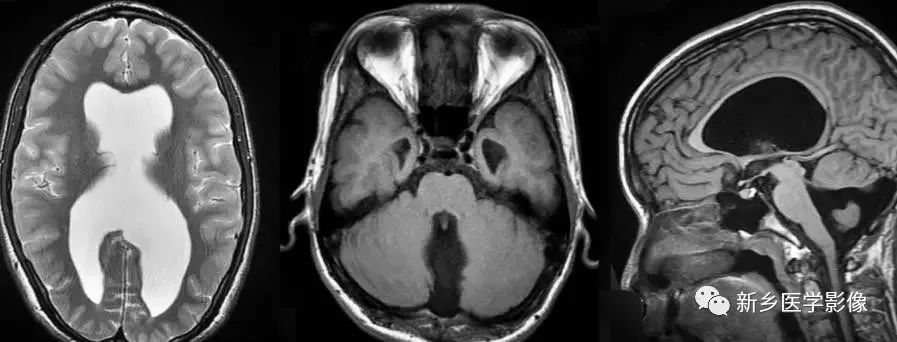 影像学脑室扩大,脑室显大怎么理解