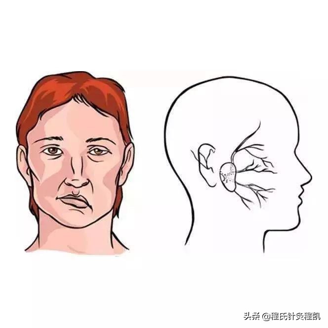 面神经炎中医诊断,面神经炎中医名称
