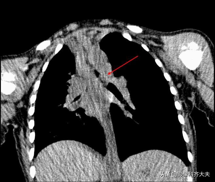 小儿气管镜怎么检查,小儿ct检查全过程视频