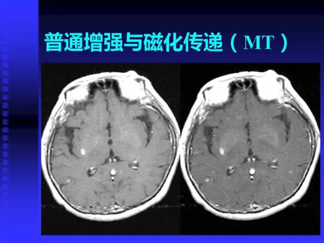 头颅mri读片视频教程,颅脑mri读片入门教程视频讲解全集