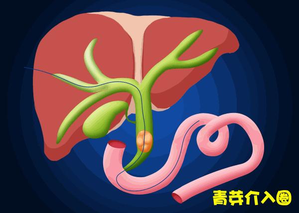 胆道阻塞眼睛发黄图片,胆管堵塞全身发黄中医治疗