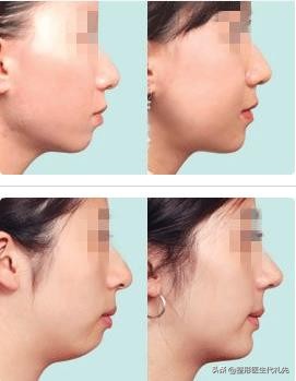 怎样才能拥有完美的下颌线,怎样让自己的下颌线更明显