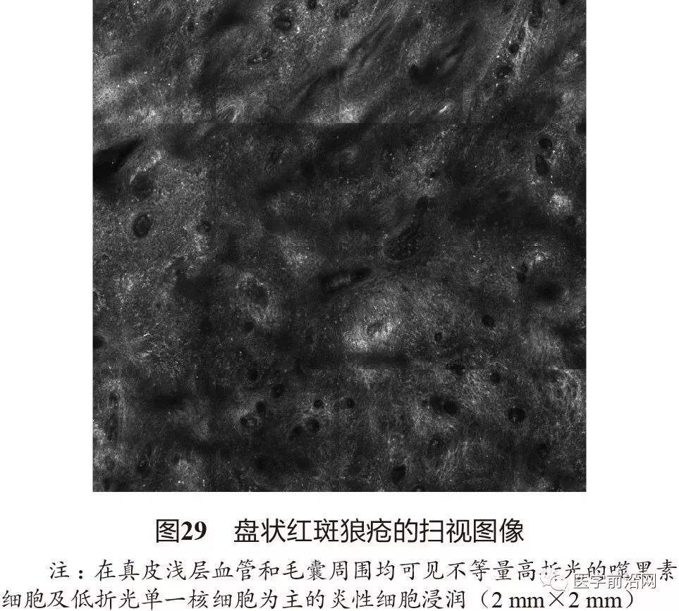 炎症性皮肤病反射式共聚焦显微镜诊断特征专家共识全文发布
