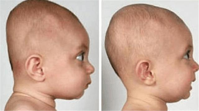 儿童睡觉不枕枕头的好处和坏处,睡枕头和不睡枕头长大后的区别