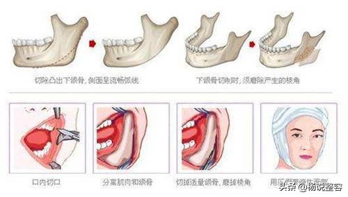 为什么会下颌突出,为什么下颌角突出
